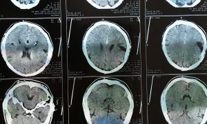 Brain injury diagnosis may hurt women’s chances in parenting disputes